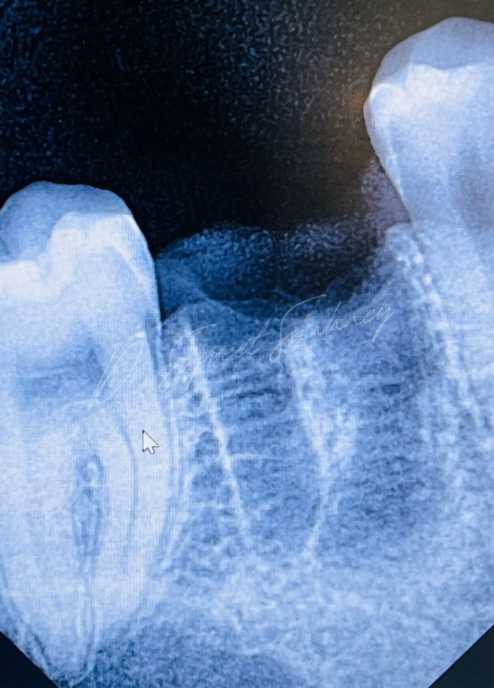 Pre-placement periapical radiograph of a posterior mandibular edentulous site